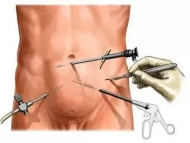 kroonilise prostatiidi kirurgiline ravi